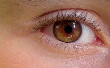 La blépharoplastie est-elle une opération remboursable ?